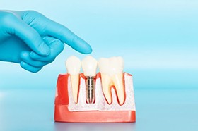 Dentist pointing to model of dental implants in Marshall