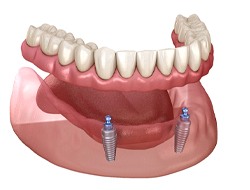 3D illustration of implant-retained lower dentures near Arkansas