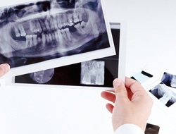 Dentist examining x-ray with multiple missing teeth in both arches