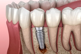 Peri-implantitis, a common cause of failed dental implants
