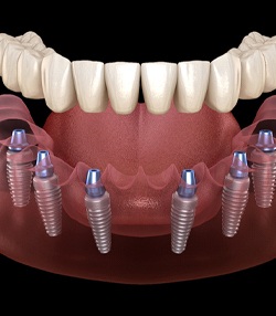 Illustration of implant-supported denture on top of six dental implants