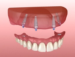 Illustration of All-on-4 implant denture for upper arch