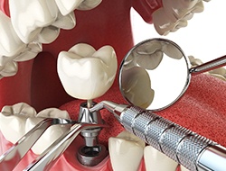 dental crown going onto implant