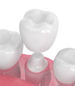 Dental crown in Marshall, TX being placed on tooth 