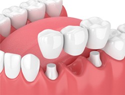 illustration traditional dental bridge in Marshall