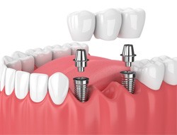 illustration implant dental bridge in Marshall