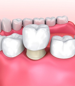 dental crown illustration