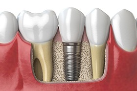 Diagram of dental implants in Marshall