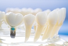 model of dental implant in Marshall