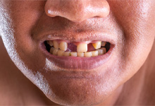 A close-up of a man with missing teeth
