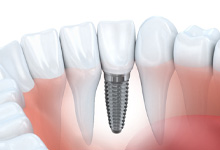 A 3D illustration of a dental implant
