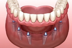 Digital image of a denture attaching to implants