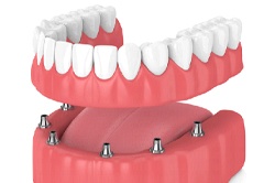 Digital image of a denture attaching to implants