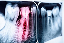 Dental X-Ray with damaged tooth highlighted in red