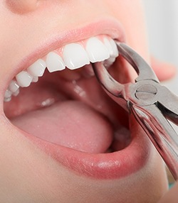 Dentist using forceps to perform simple extraction