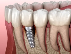 Illustration of peri-implantitis, a common cause of implant failure