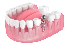 Dental implant, abutment, and crown to replace one tooth