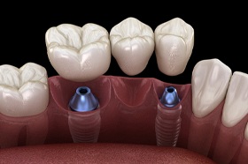 Dental implant bridge to replace three teeth in a row