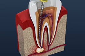Illustration of tool being used to clean out root canal