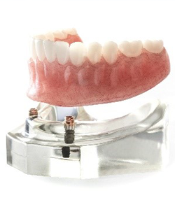 Implant Dentures