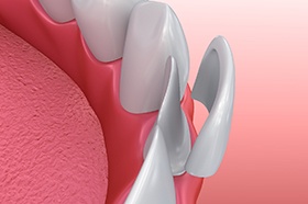 Illustration of veneers in Marshall being placed