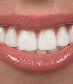 Close-up of woman’s beautiful smile with veneers in Marshall