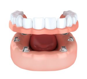Implant-retained Dentures