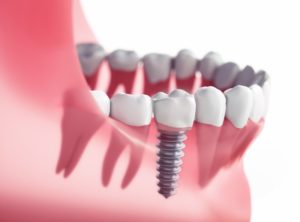 Dental Implants