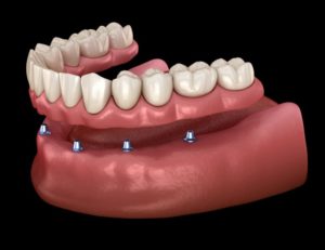 Illustration of implant-retained dentures in Marshall being placed on dental implants