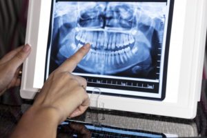 Dentist in Marshall pointing to dental X-Rays on monitor