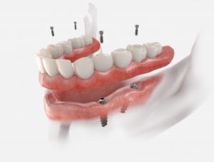 3D implant dentures illustration