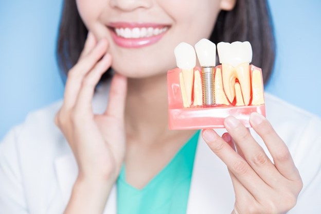 Image of dental implants. 