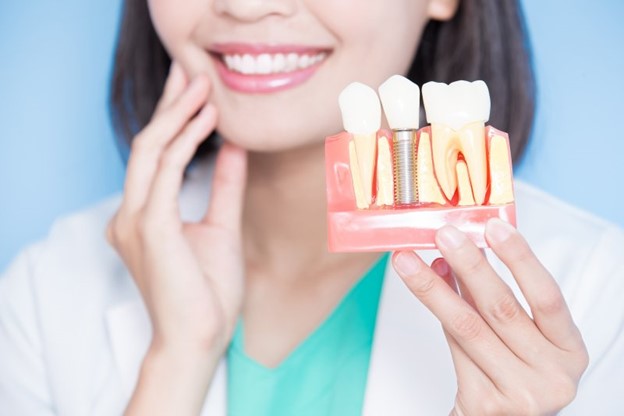 Image of dental implants.