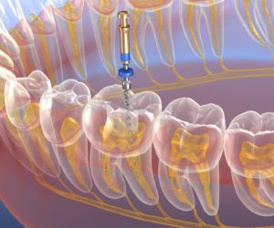 Illustration of tool being used to perform root canal in Marshall