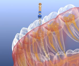 Illustration of tool cleaning tooth’s interior during root canal in Marshall