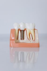 Dental implant model on counter